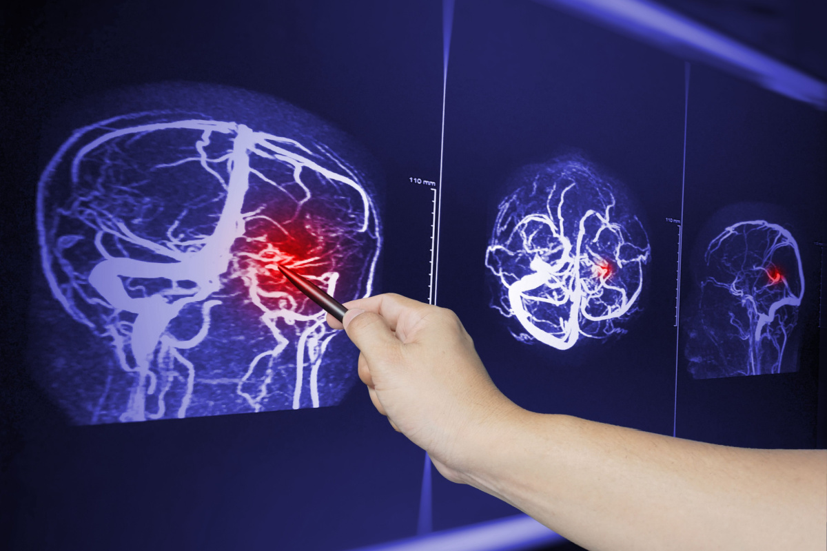 Traumatic Brain Injuries